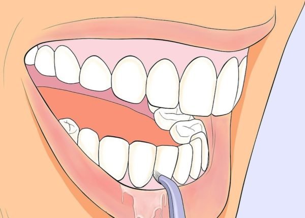Очистка ротовой полости ирригатором