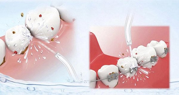 Чистка брекетов ирригатором