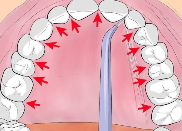Очистка ротовой полости ирригатором